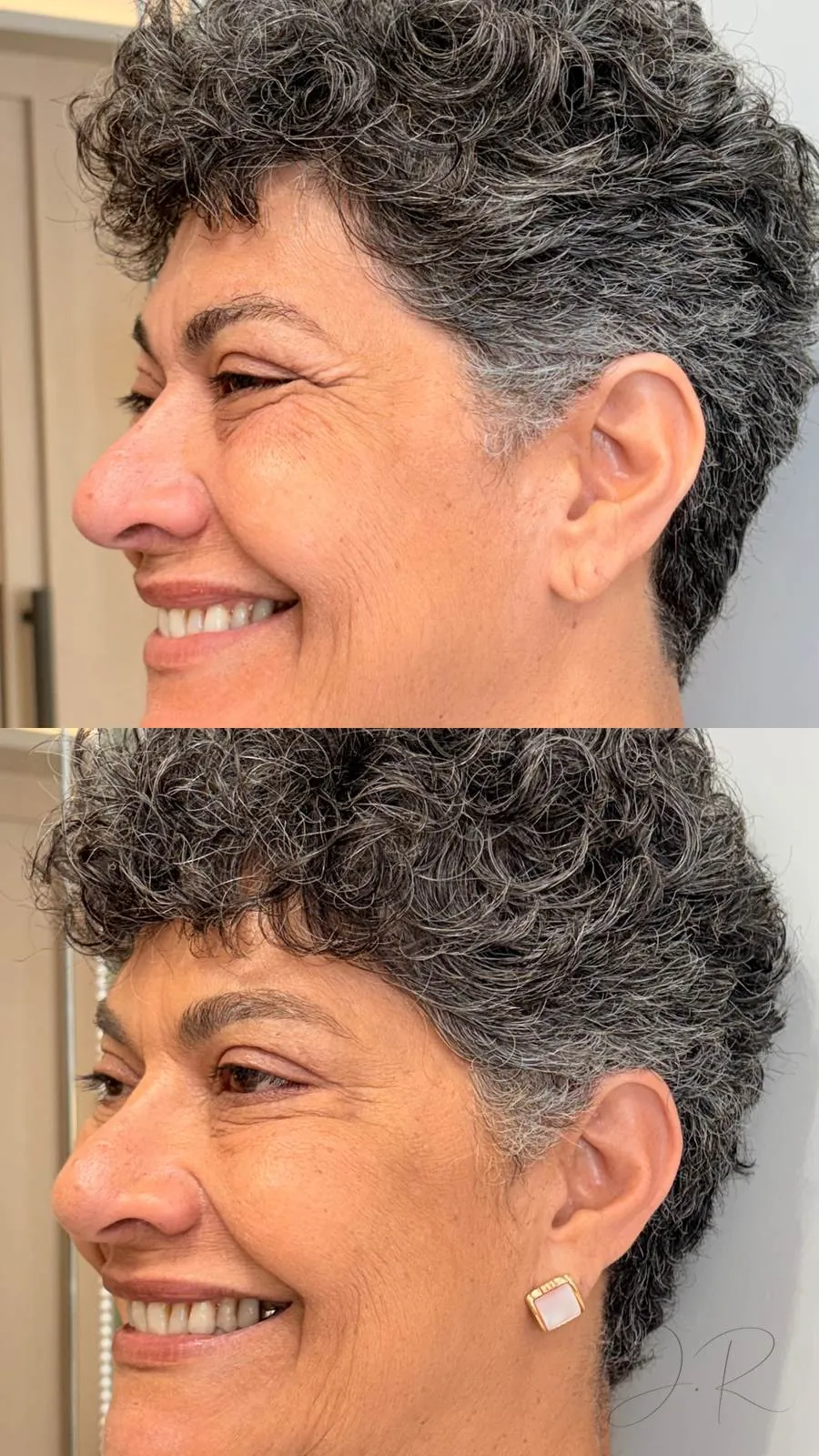 Antes e depois de bioestimulador de colágeno, com melhora na firmeza e textura da pele