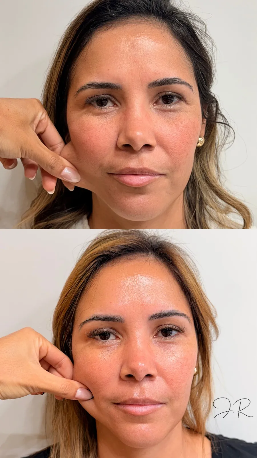 Antes e depois de bioestimulador de colágeno, segundo caso, com melhora na textura da pele