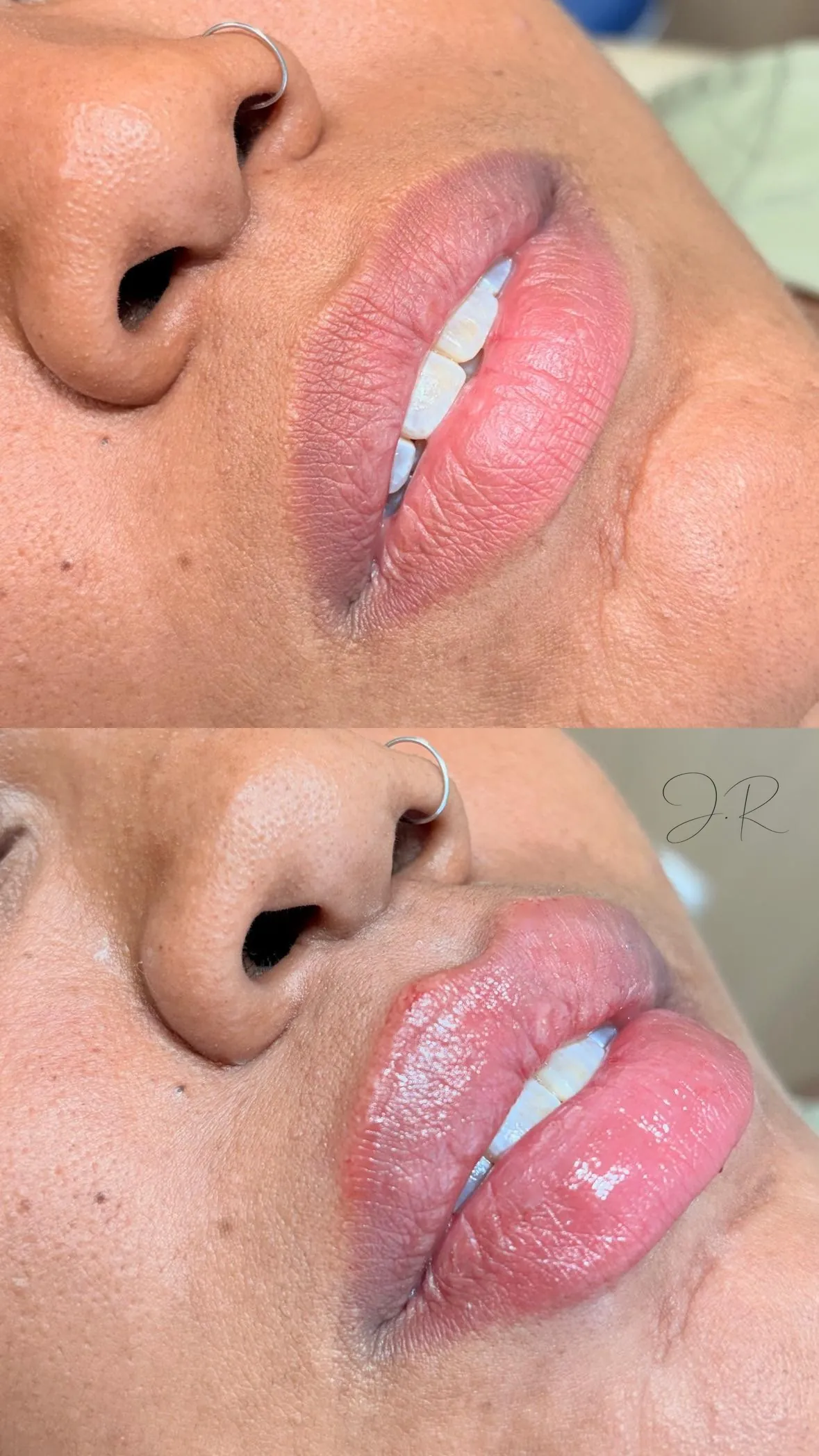 Antes e depois de preenchimento labial, close da regiao da boca com piercing de nariz