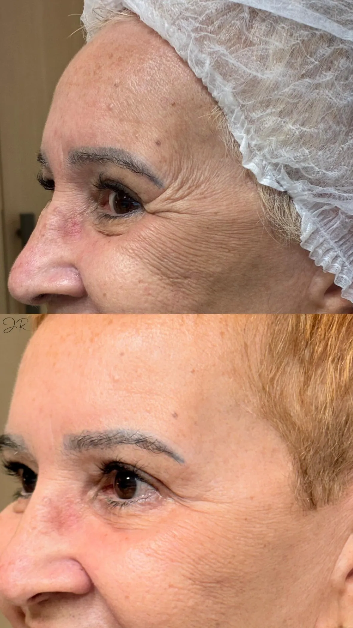 Antes e depois de toxina botulinica, perfil do olho e testa
