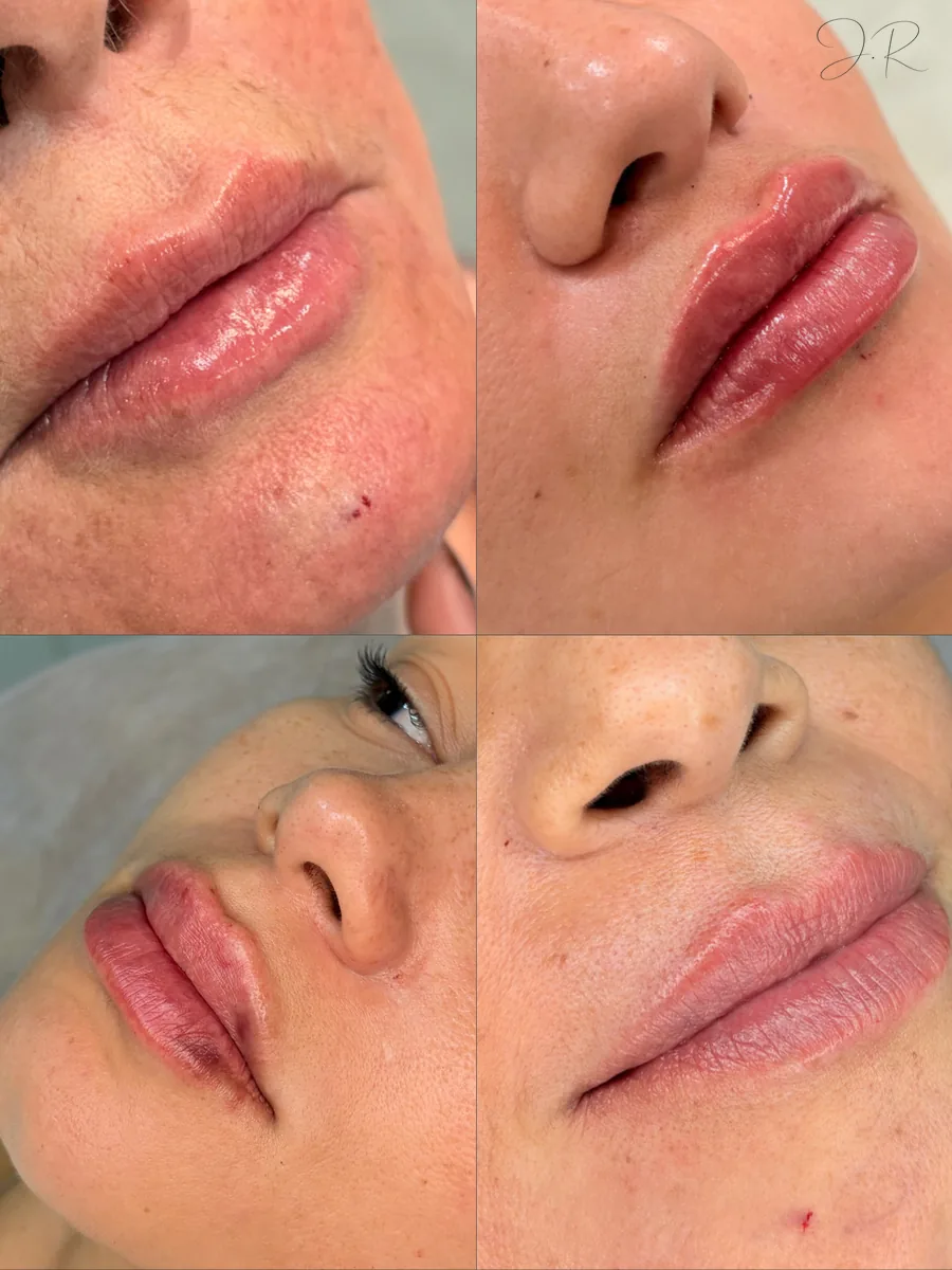 Antes e depois de preenchimento labial em três ângulos