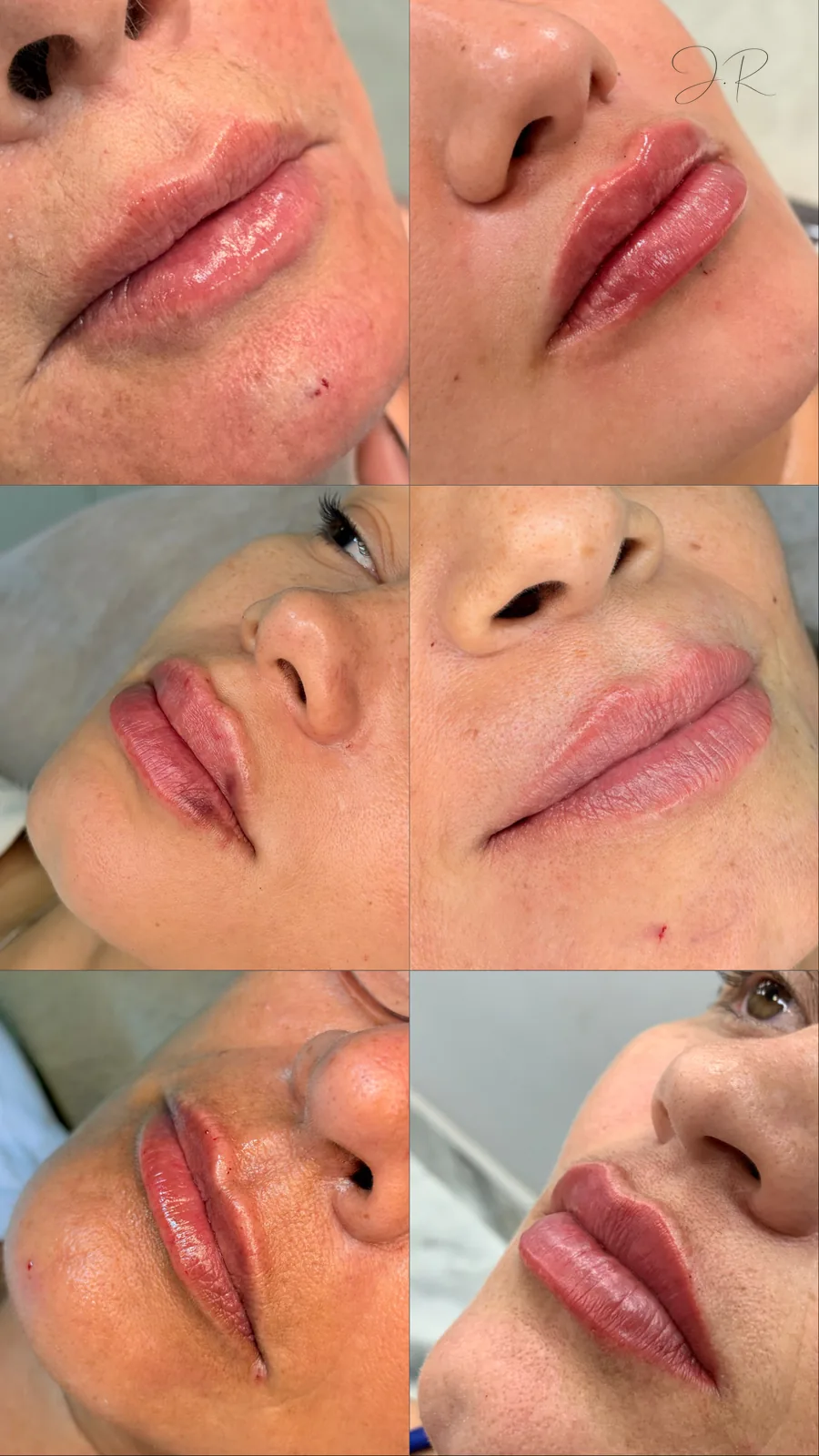 Antes e depois de preenchimento labial em três ângulos