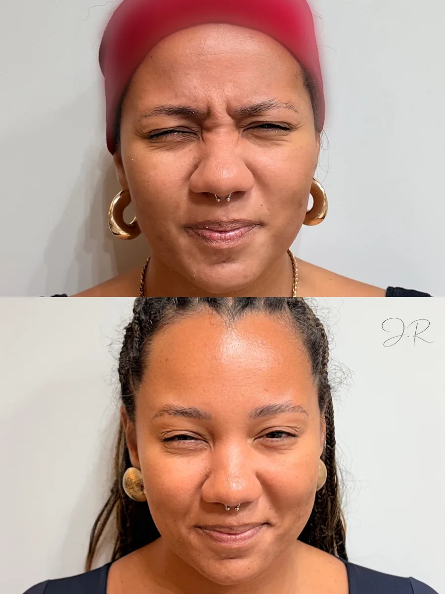 Antes e depois de toxina botulínica entre as sobrancelhas