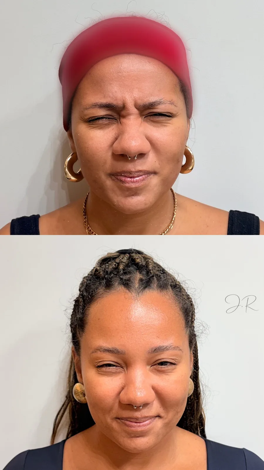 Antes e depois de toxina botulínica entre as sobrancelhas