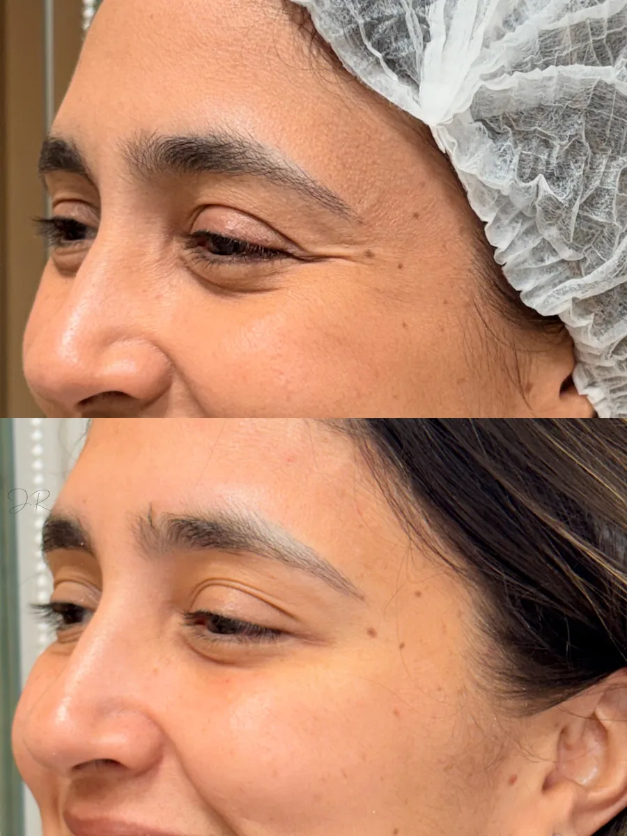 Antes e depois de toxina botulínica ao redor dos olhos, perfil