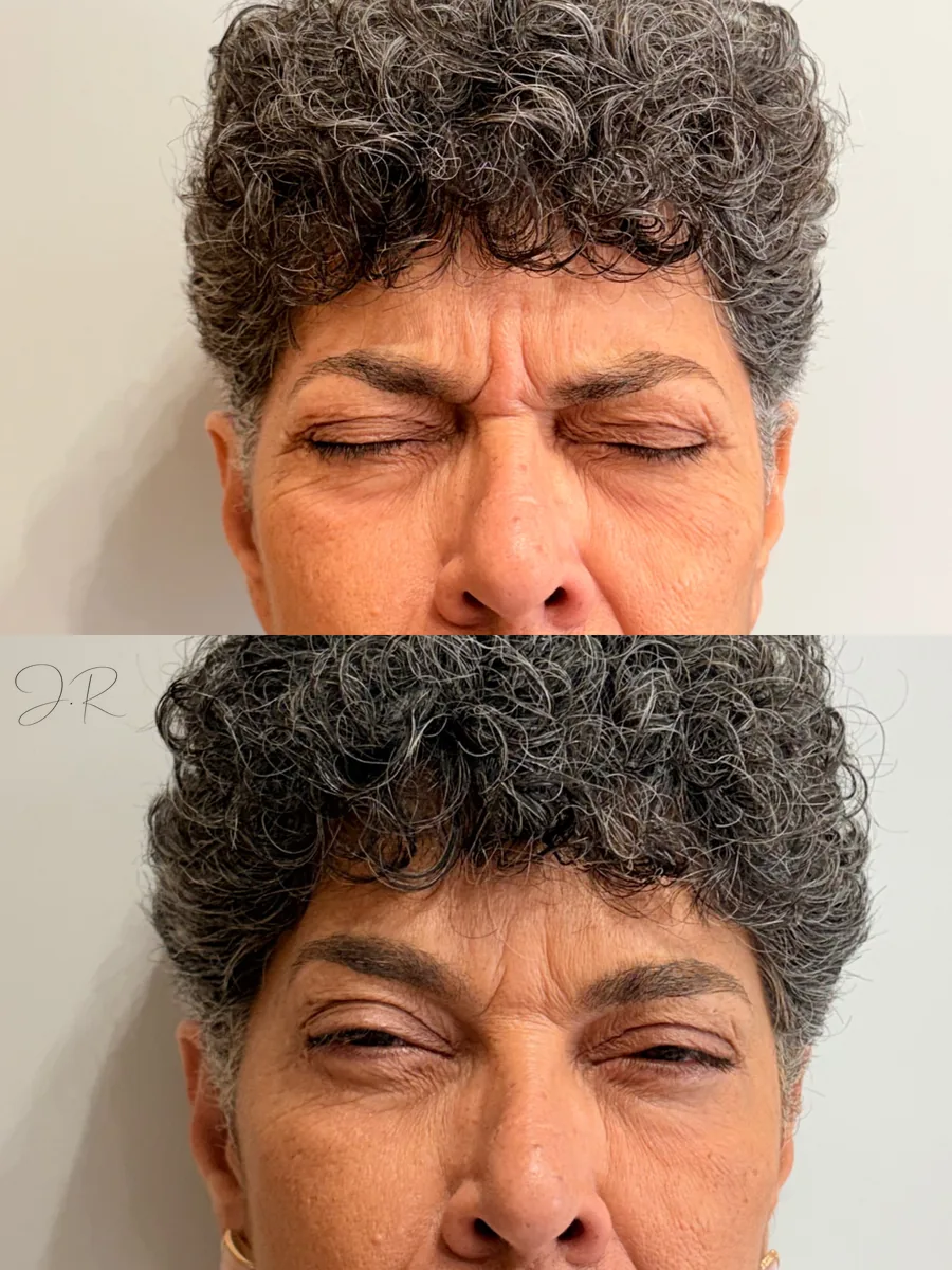 Antes e depois de toxina botulínica ao redor dos olhos