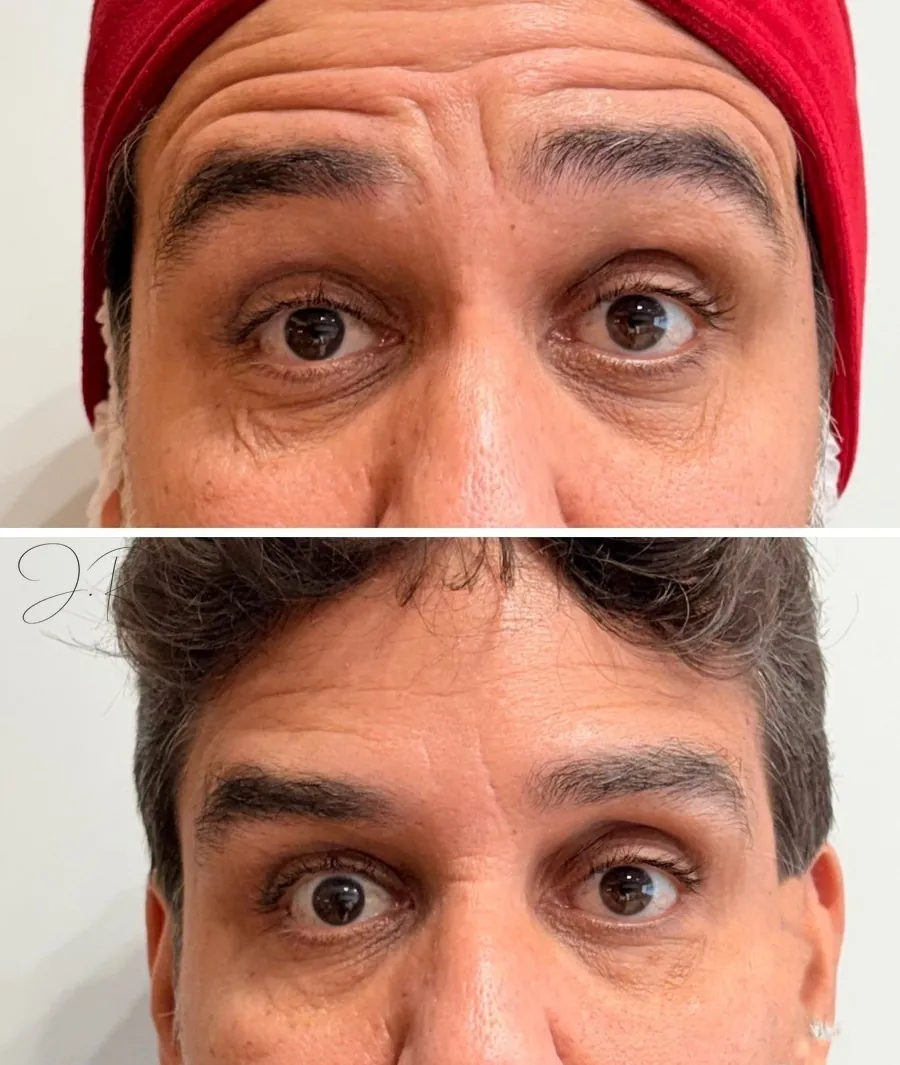Antes e depois de toxina botulínica na testa, com suavização das linhas de expressão