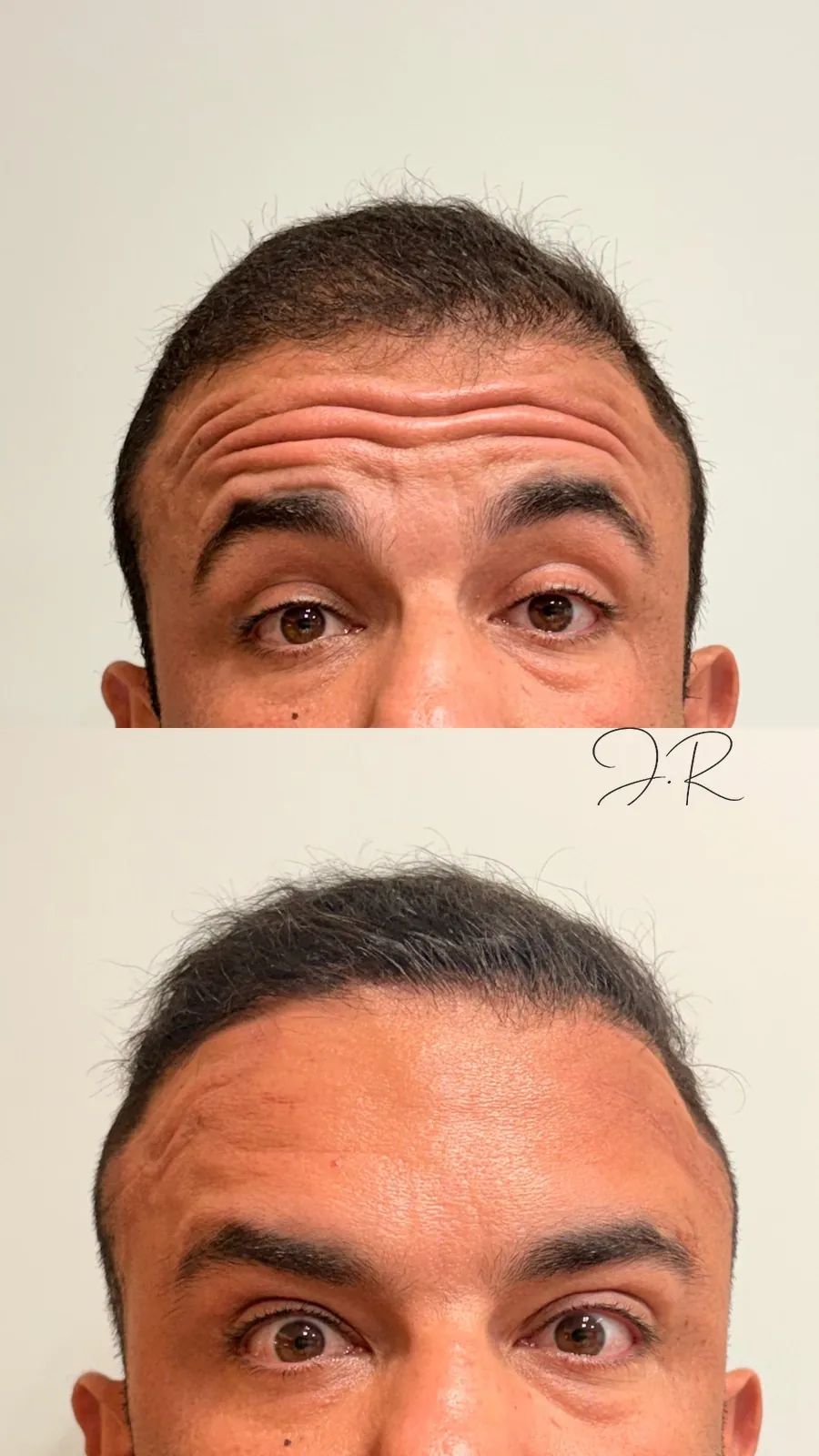Antes e depois de toxina botulínica na testa, segundo caso, com suavização das linhas de expressão