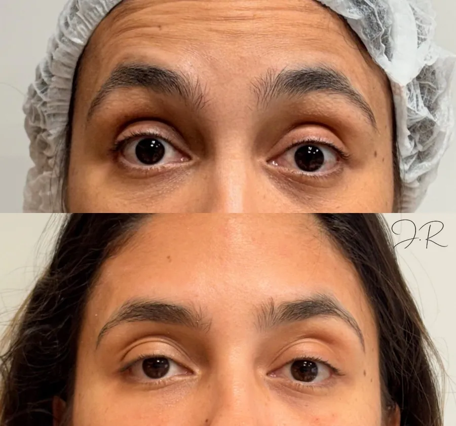 Antes e depois de toxina botulinica na testa, testa e sobrancelhas em close