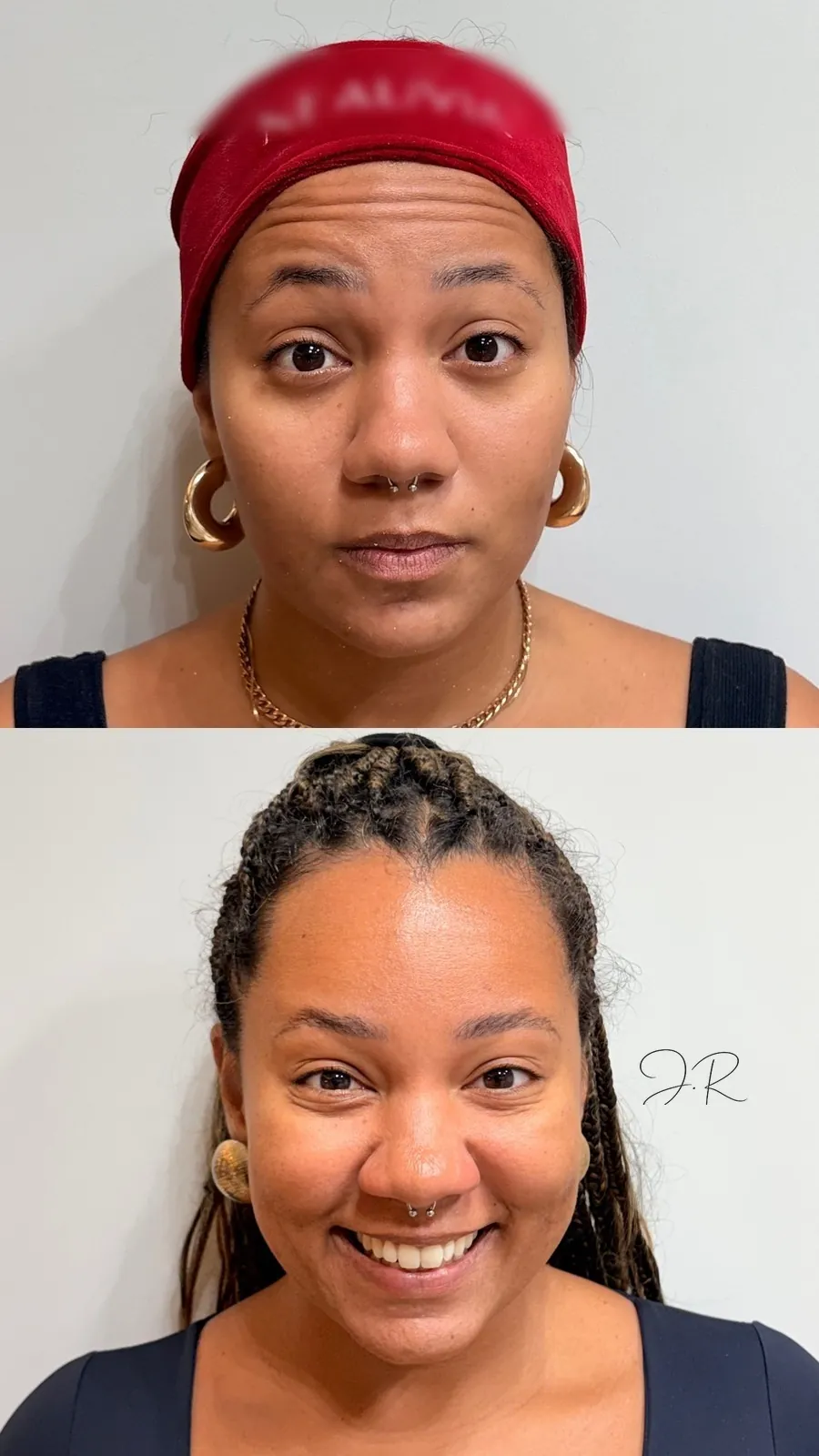 Antes e depois de toxina botulínica na testa, quarto caso