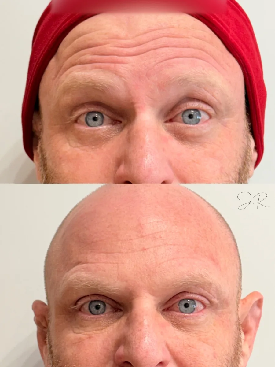 Antes e depois de toxina botulínica na testa