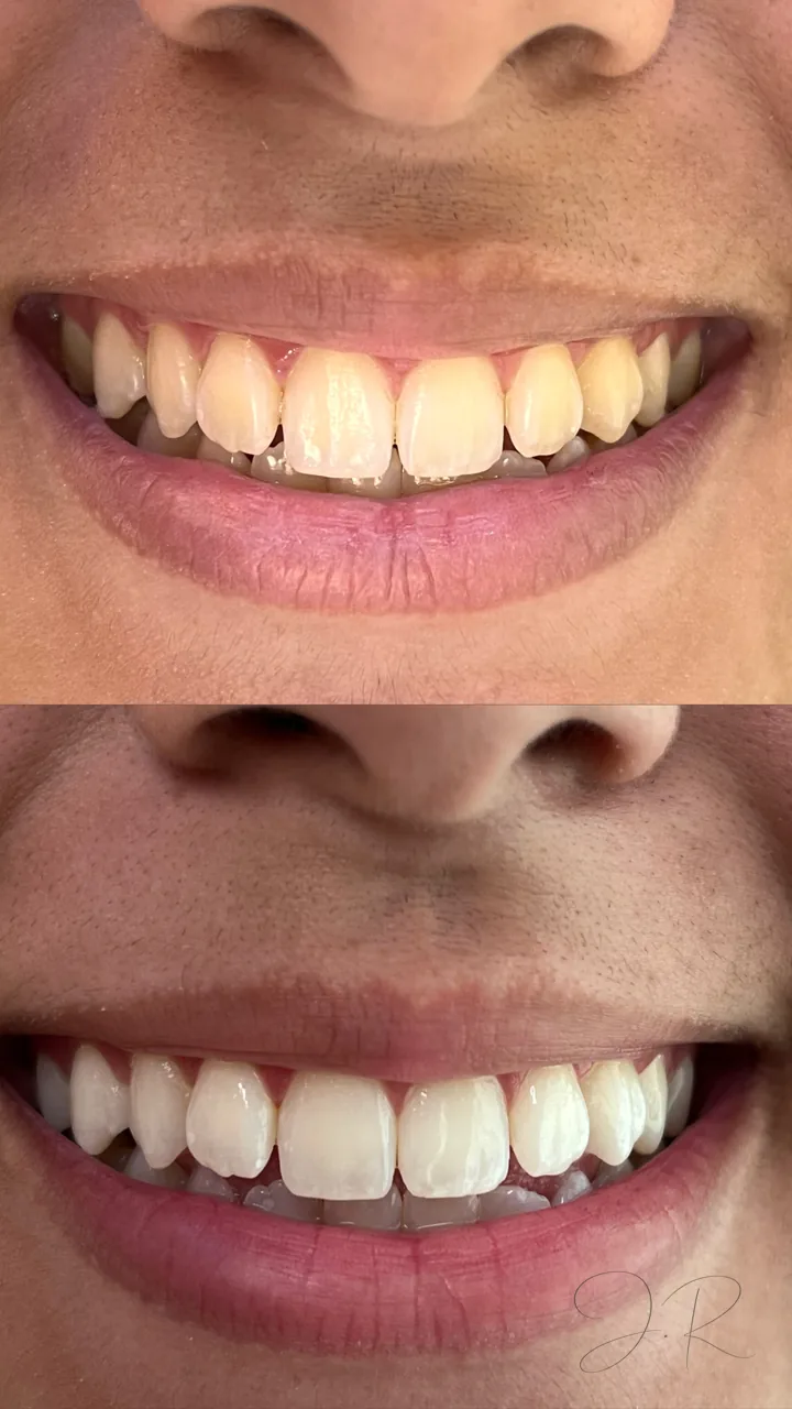 Antes e depois de clareamento dental, close do sorriso, caso 1