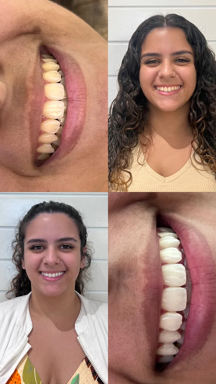 Antes e depois de clareamento dental, sorriso de perfil e de frente, caso 2