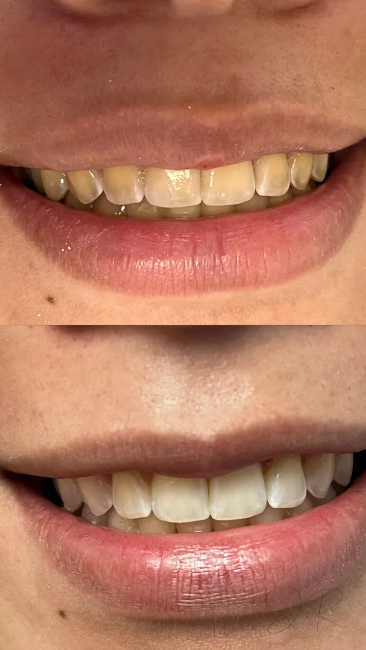 Antes e depois de clareamento dental, close do sorriso, caso 3